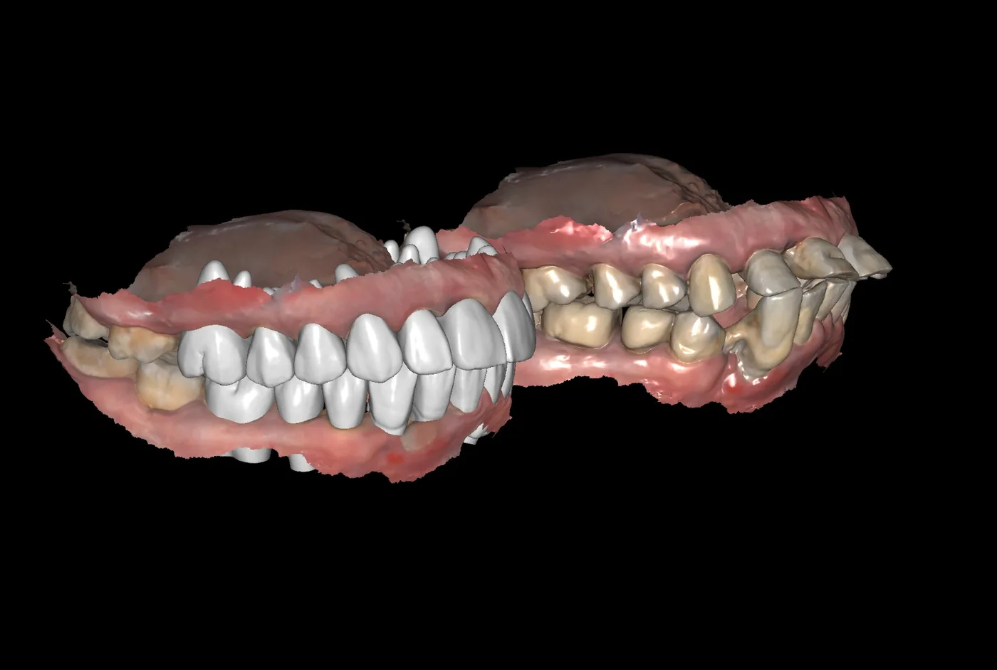 Diseño digital CAD de la rehabilitación dental sobre el escaneado 3D del paciente