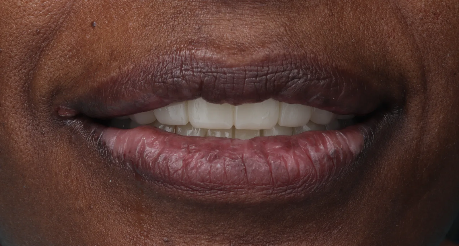 Sonrisa rehabilitada de una paciente de FF Dental Group